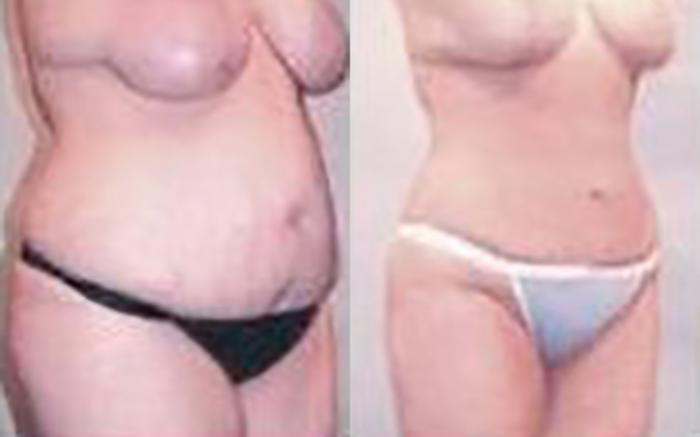 Before & After Liposuction Case 3941 View 2 View in Houston, TX