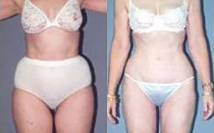 Before & After Liposuction Case 3947 View 1 View in Houston, TX
