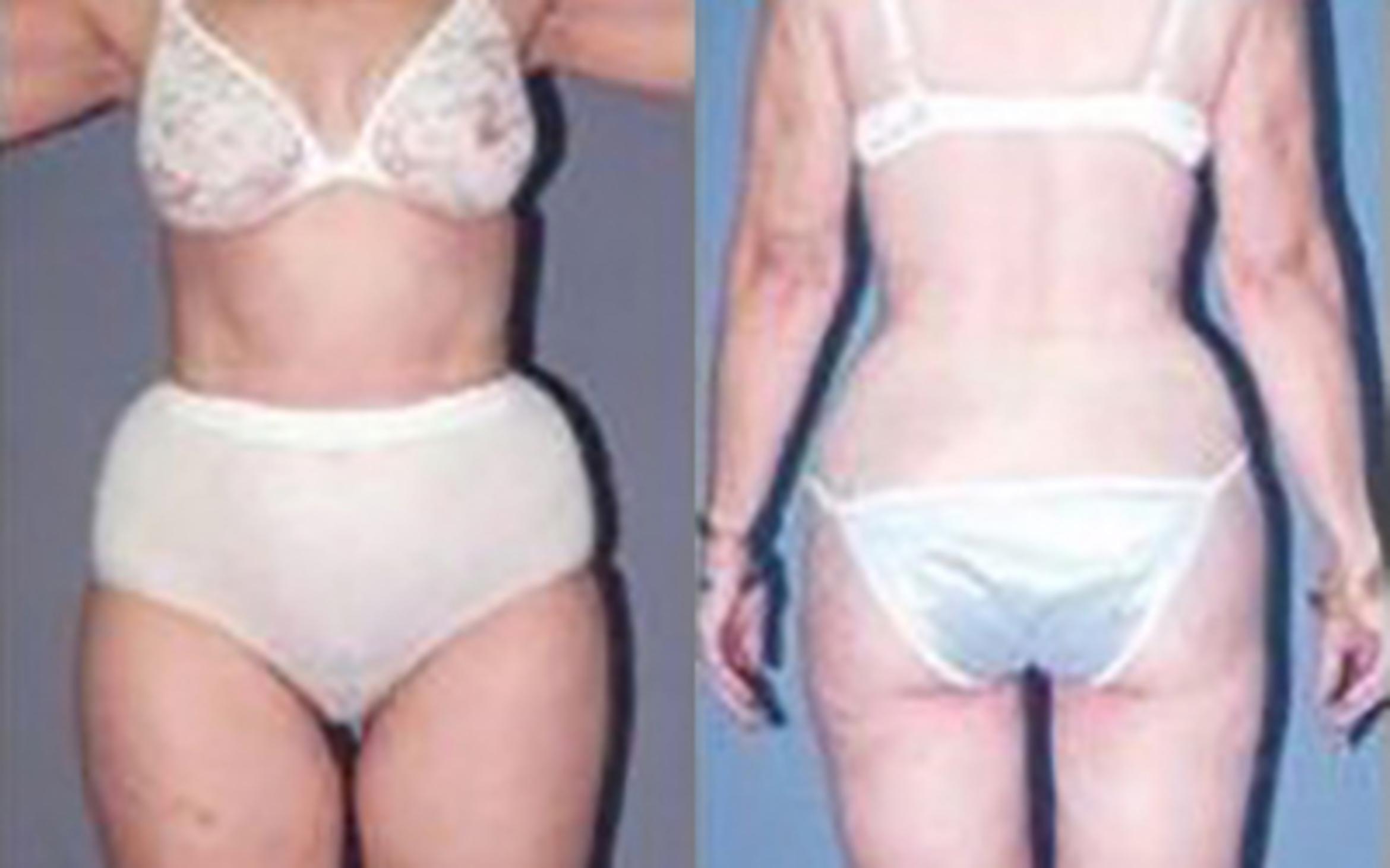 Before & After Liposuction Case 3947 View 2 View in Houston, TX