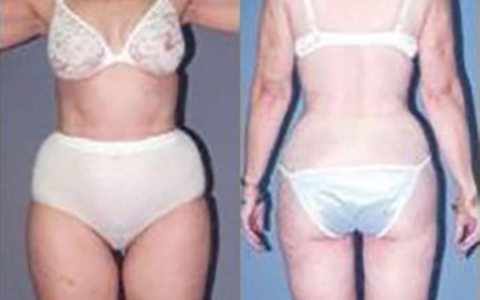 Before & After Liposuction Case 3947 View 2 View in Houston, TX