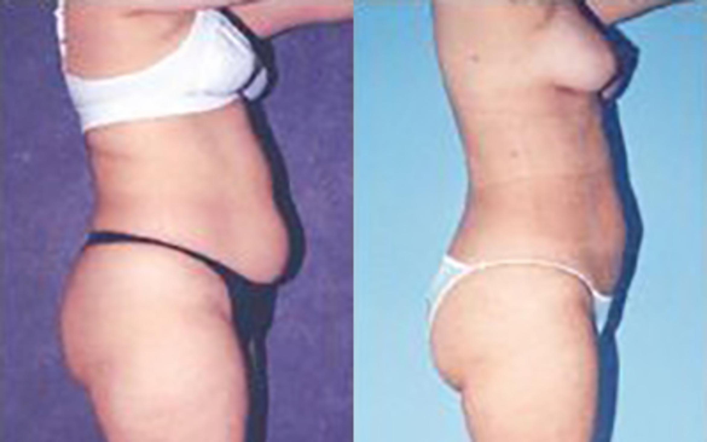 Before & After Liposuction Case 3953 View 1 View in Houston, TX