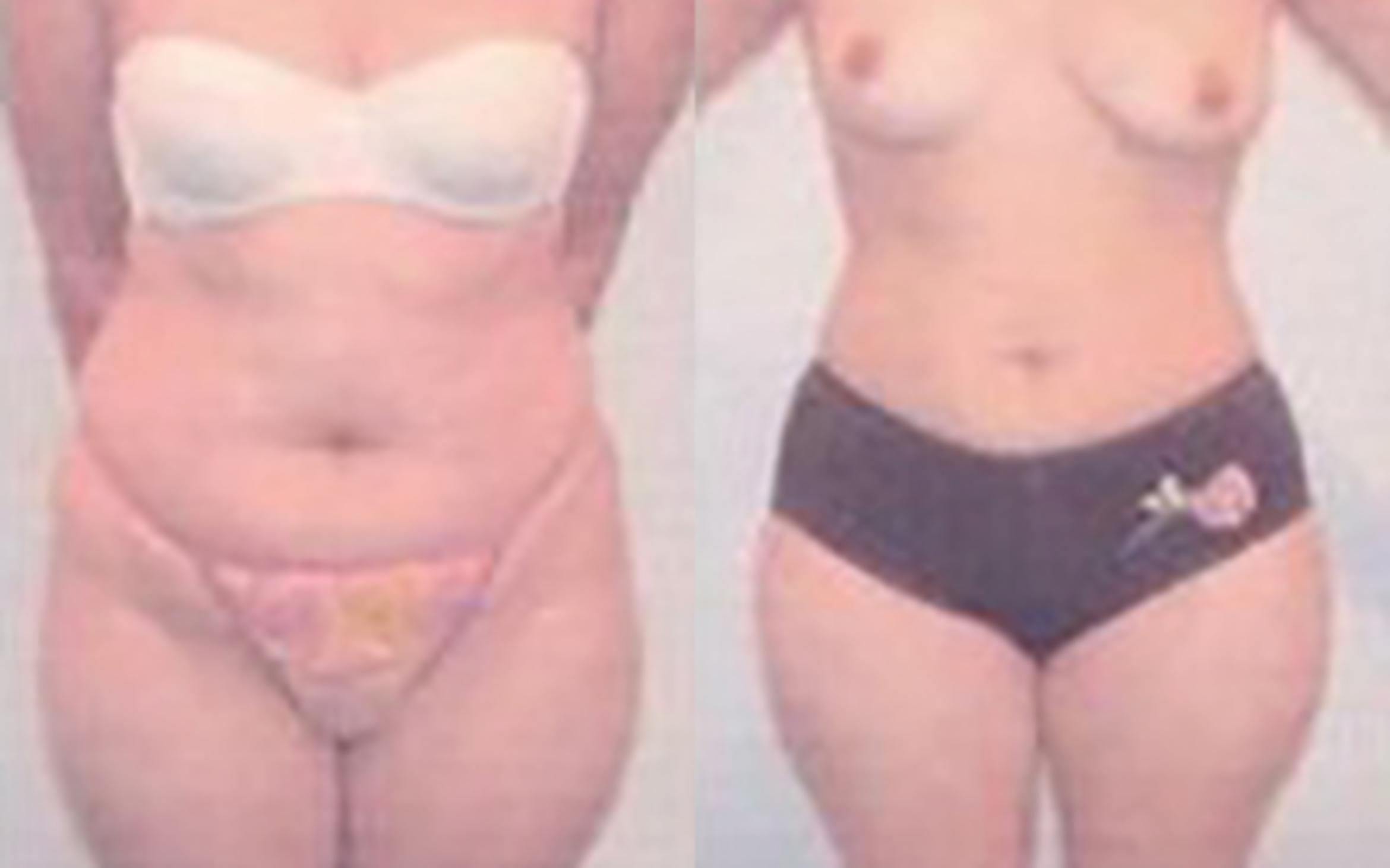 Before & After Liposuction Case 3957 View 1 View in Houston, TX