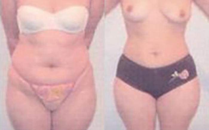 Before & After Liposuction Case 3957 View 1 View in Houston, TX