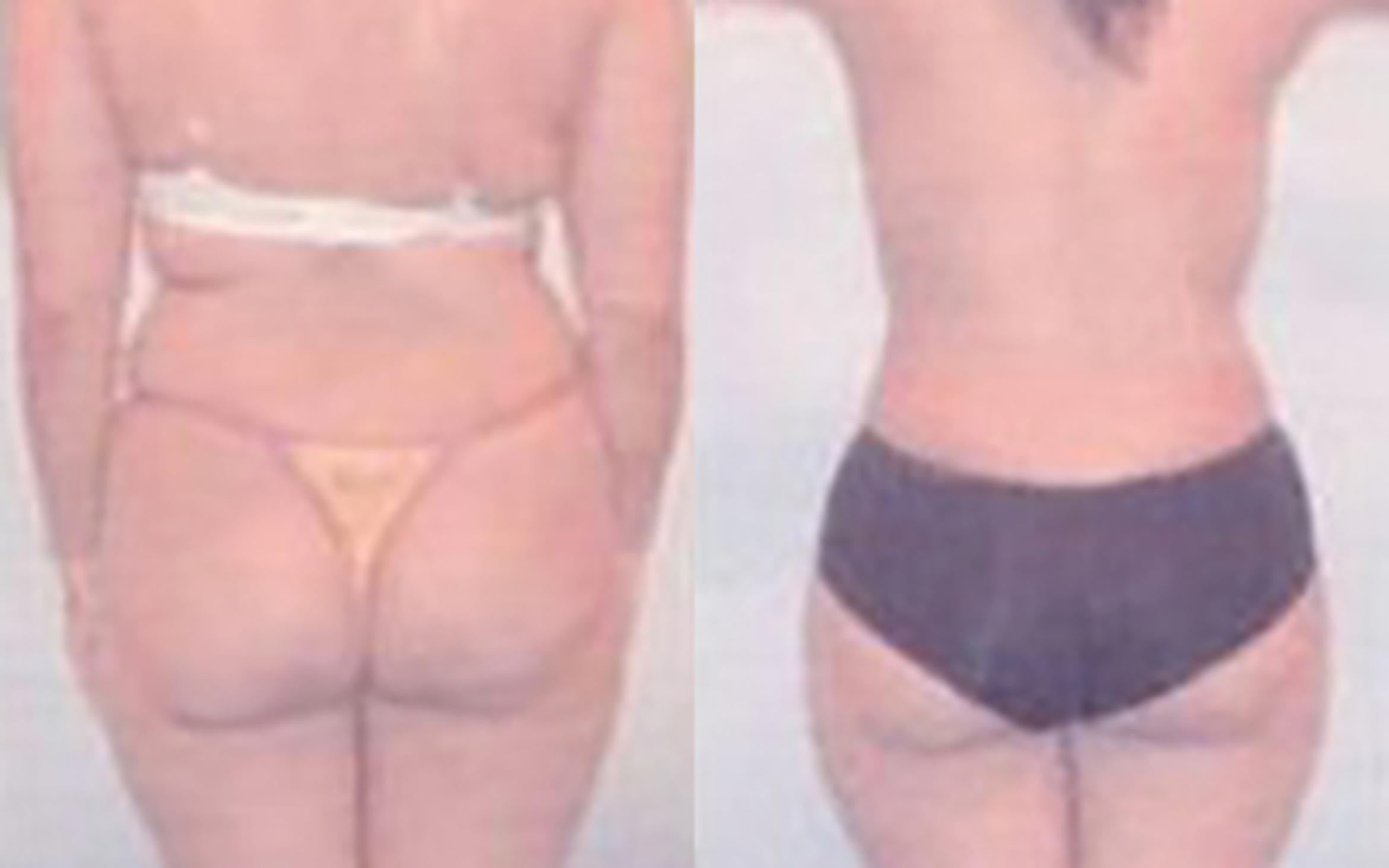 Before & After Liposuction Case 3957 View 2 View in Houston, TX