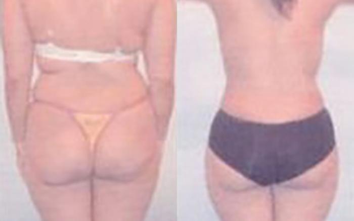 Before & After Liposuction Case 3957 View 2 View in Houston, TX