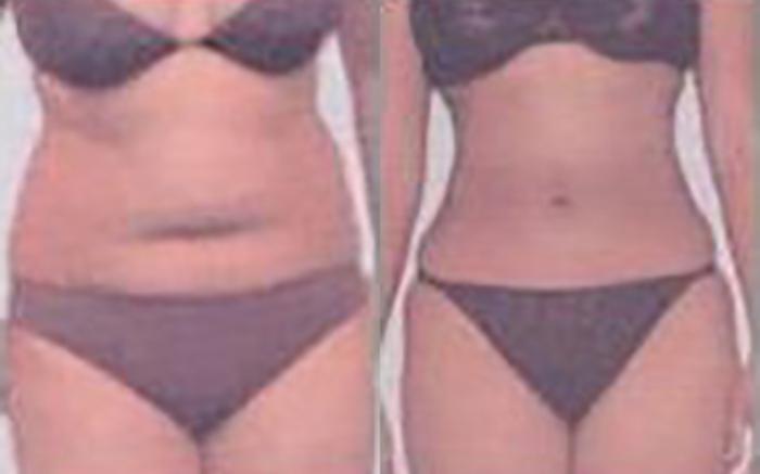Before & After Liposuction Case 3963 View 1 View in Houston, TX