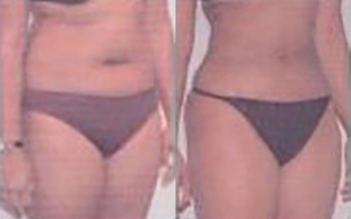 Before & After Liposuction Case 3963 View 2 View in Houston, TX