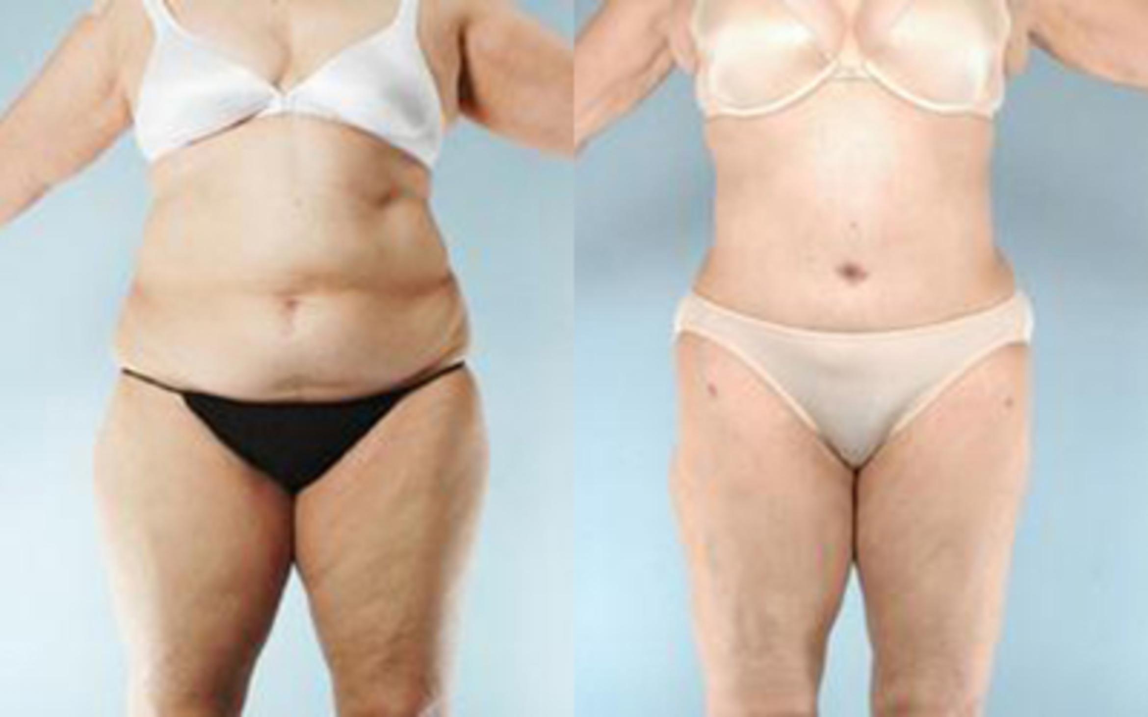 Before & After Liposuction Case 3969 View 1 View in Houston, TX