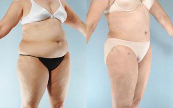 Before & After Liposuction Case 3969 View 2 View in Houston, TX