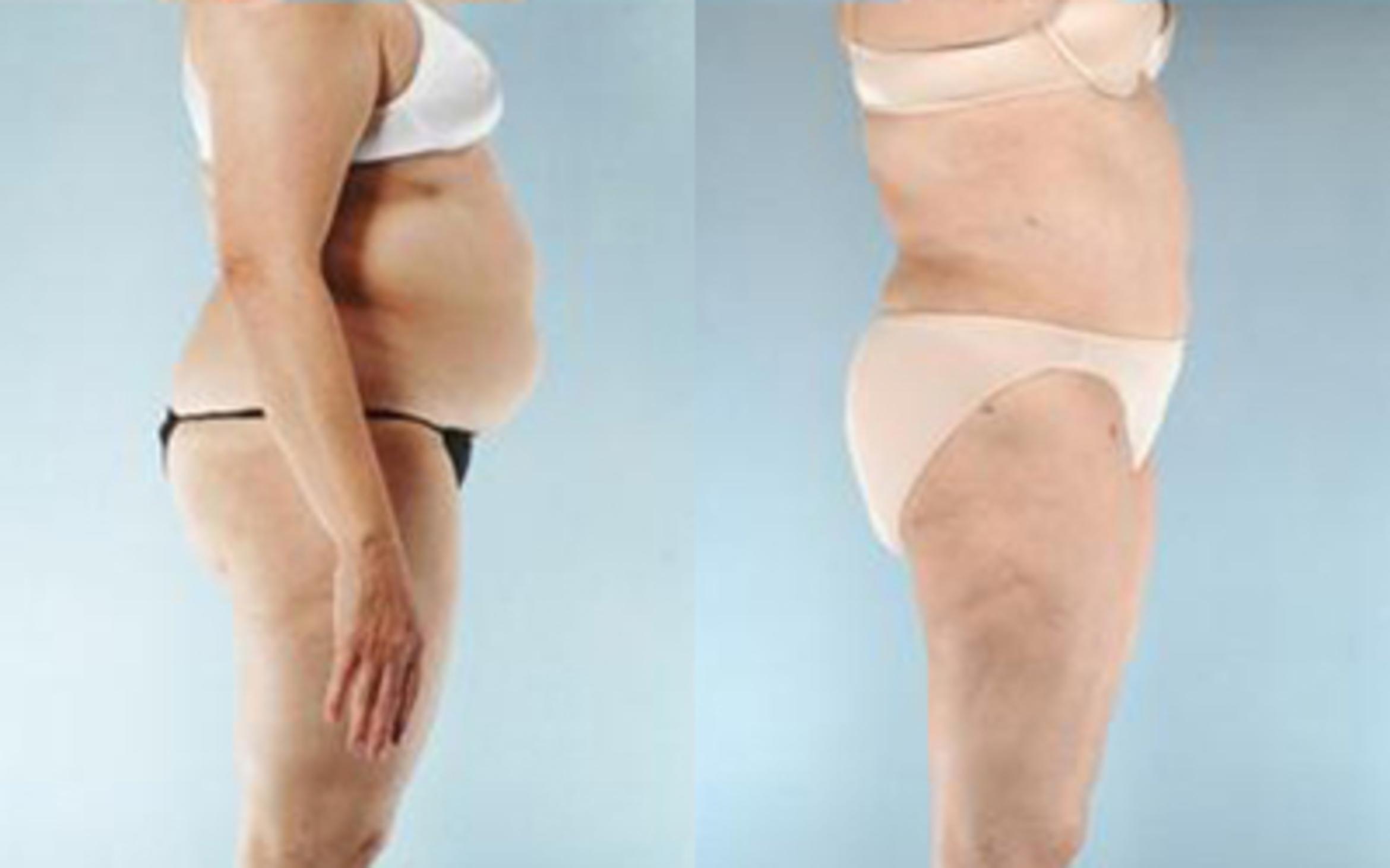 Before & After Liposuction Case 3969 View 3 View in Houston, TX