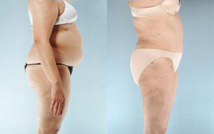 Before & After Liposuction Case 3969 View 3 View in Houston, TX