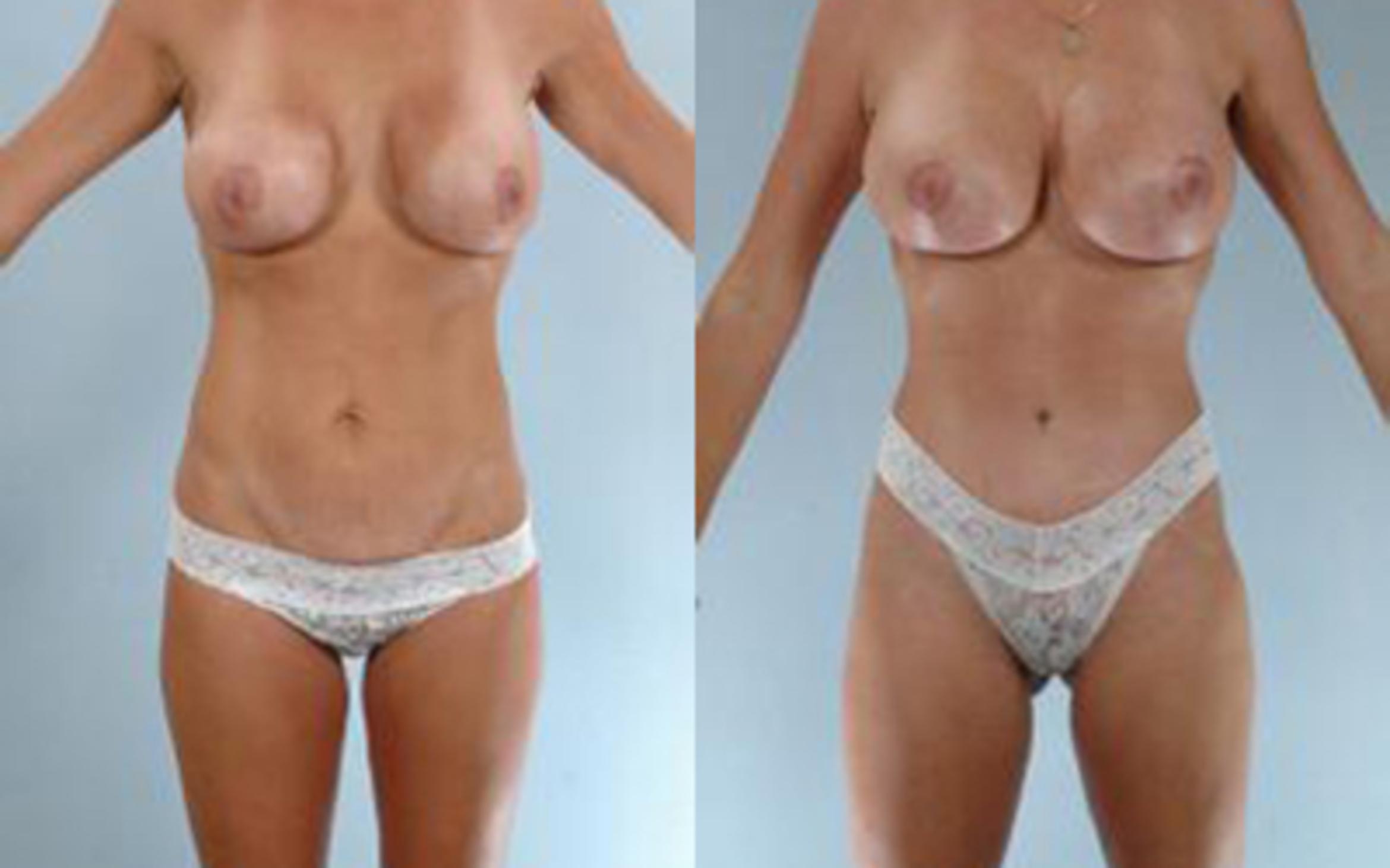 Before & After Liposuction Case 3979 View 1 View in Houston, TX