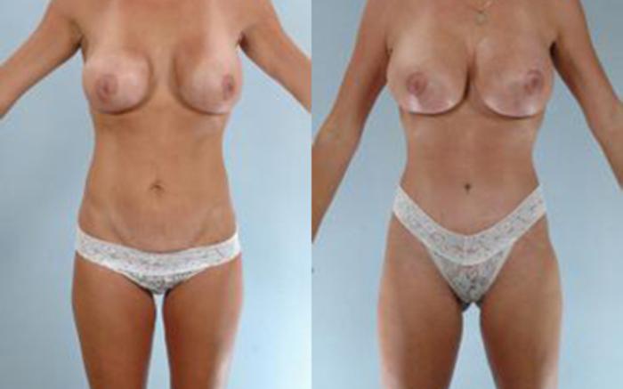 Before & After Liposuction Case 3979 View 1 View in Houston, TX