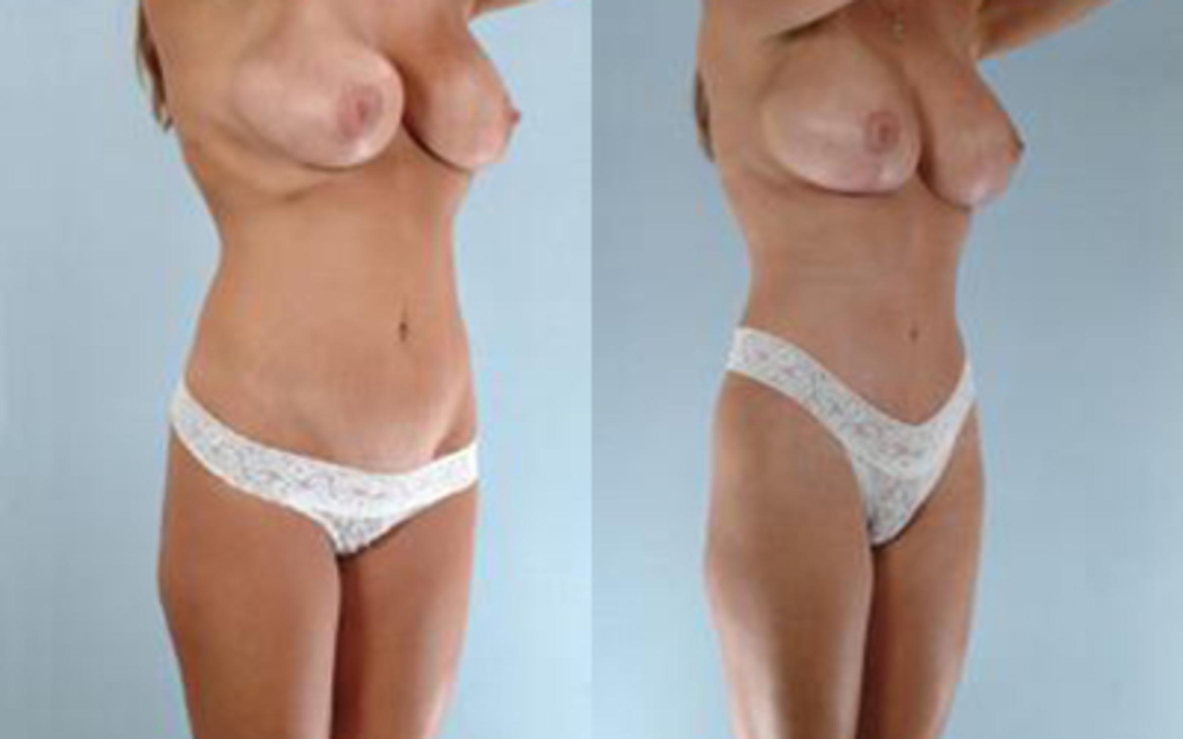 Before & After Liposuction Case 3979 View 2 View in Houston, TX