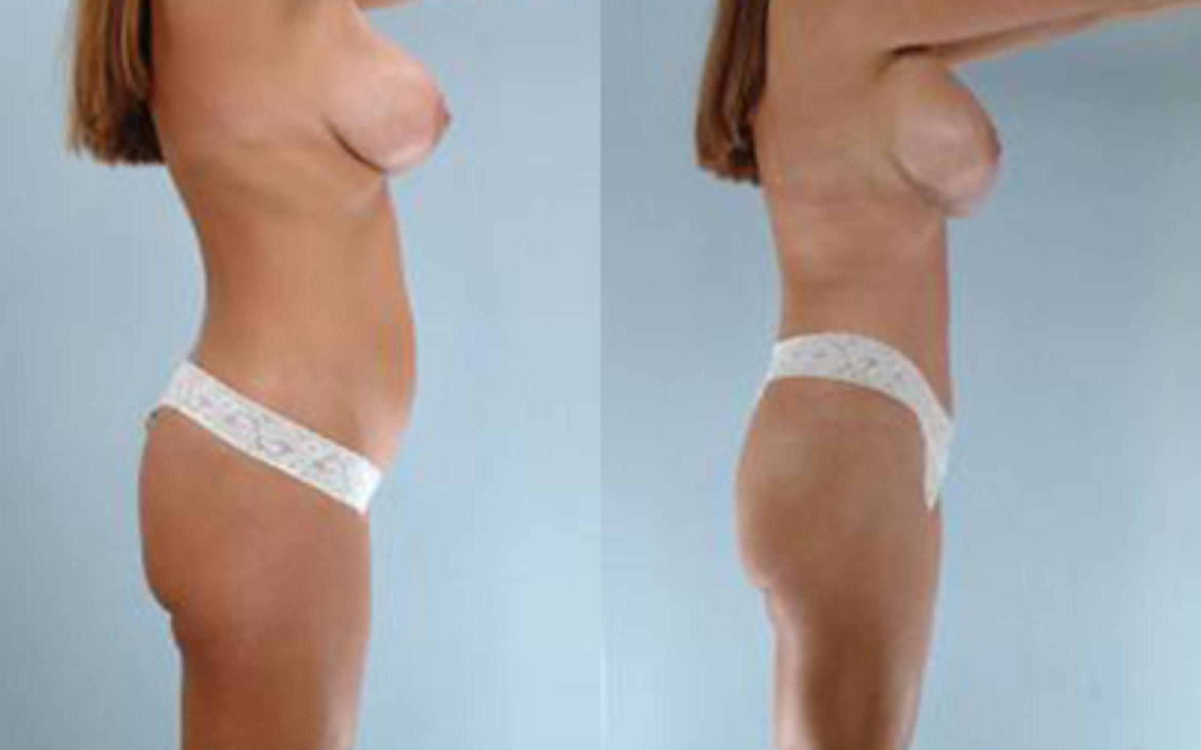 Before & After Liposuction Case 3979 View 3 View in Houston, TX
