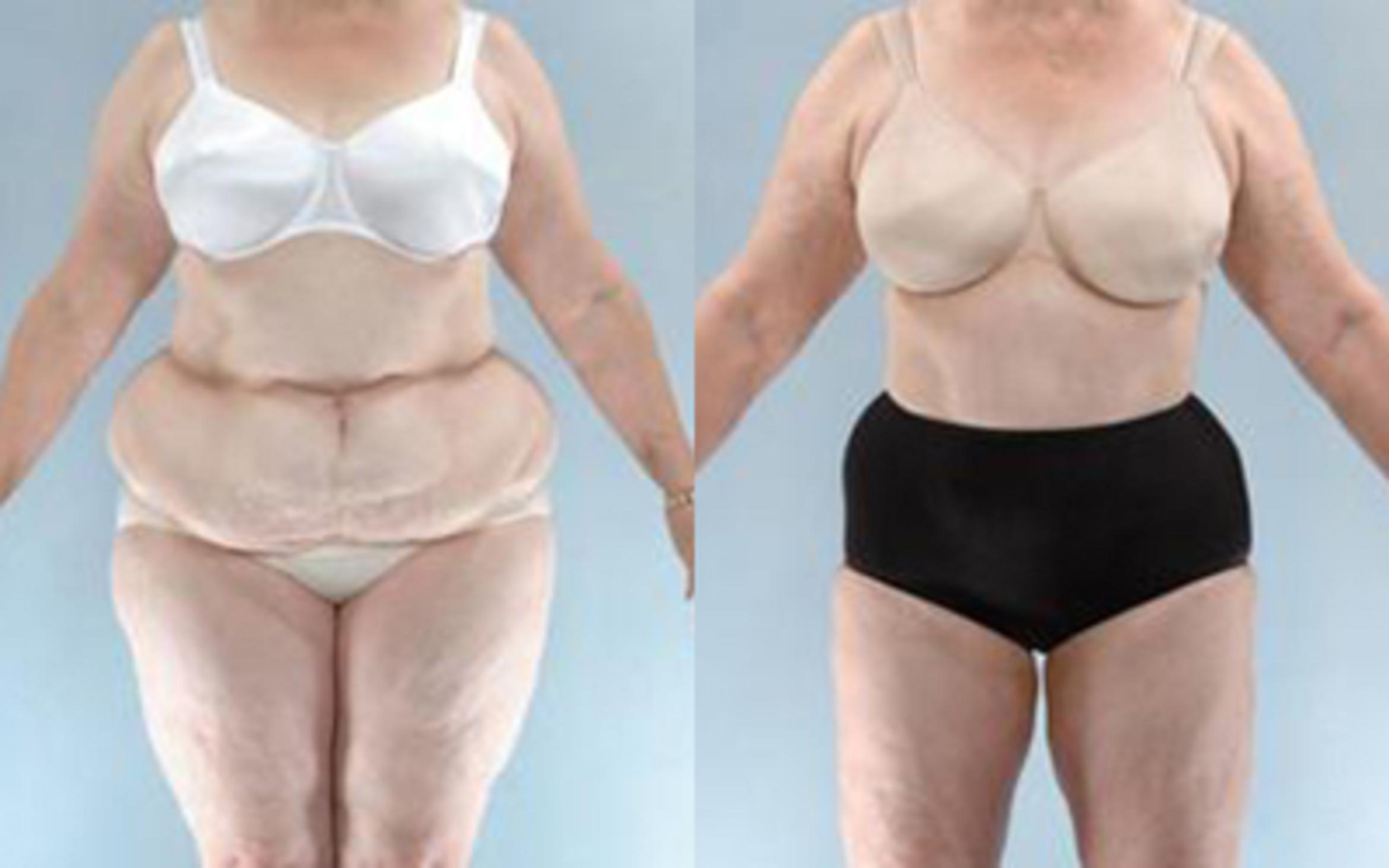 Before & After Liposuction Case 3987 View 1 View in Houston, TX