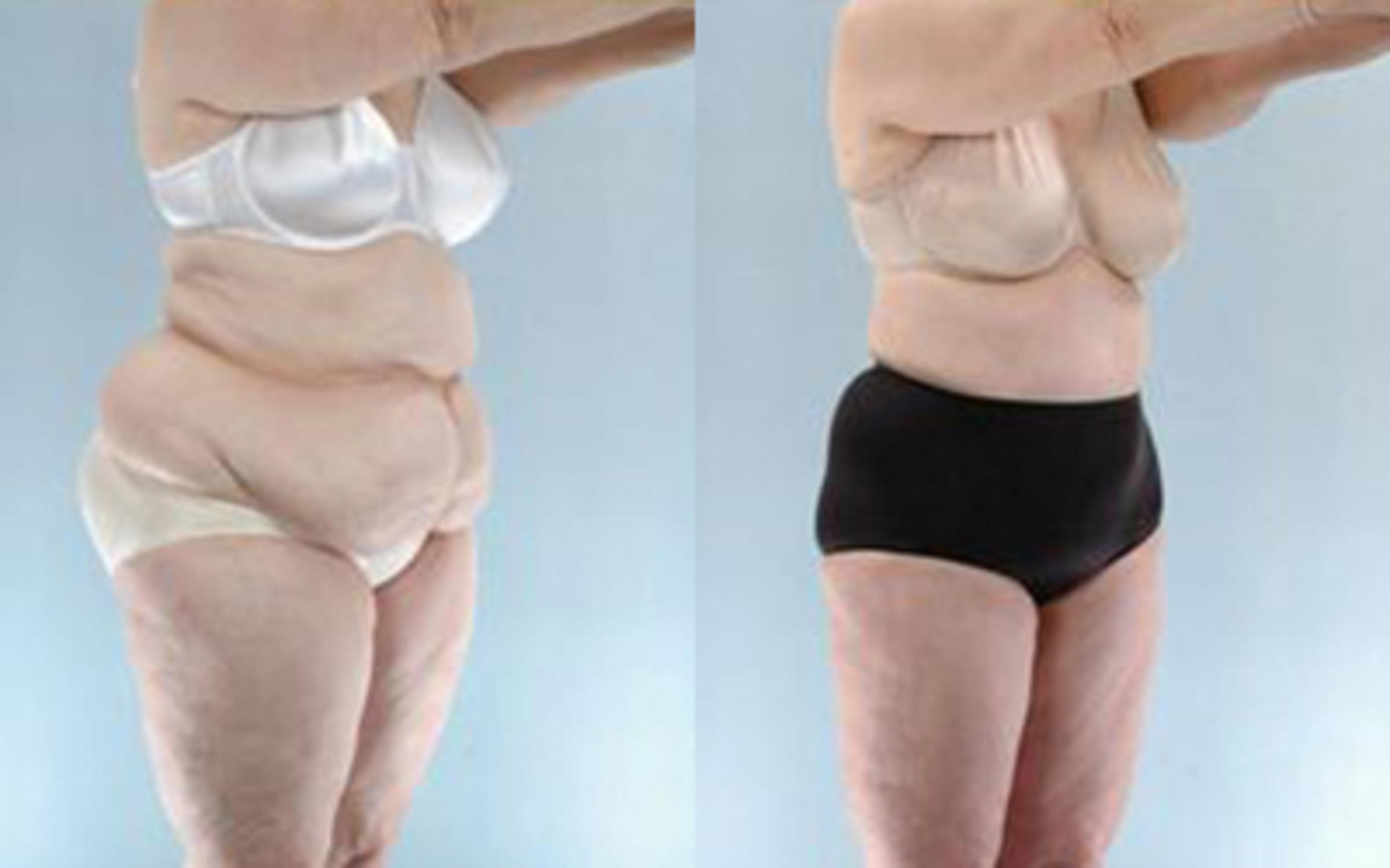 Before & After Liposuction Case 3987 View 2 View in Houston, TX