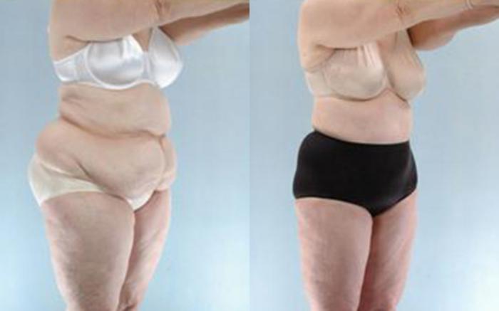 Before & After Liposuction Case 3987 View 2 View in Houston, TX