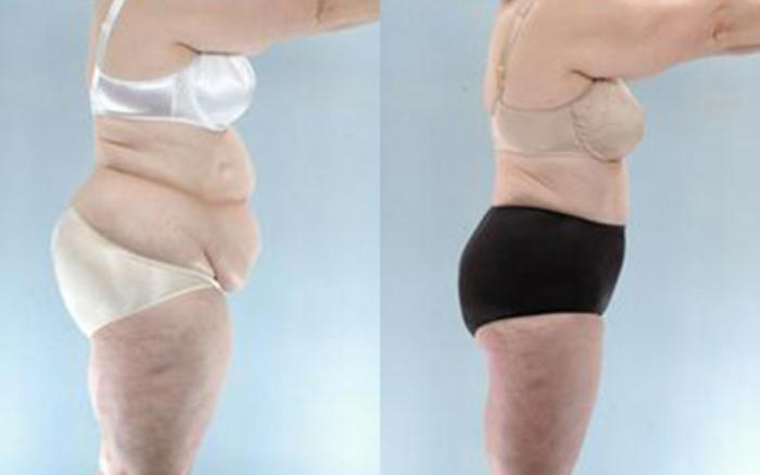 Before & After Liposuction Case 3987 View 3 View in Houston, TX