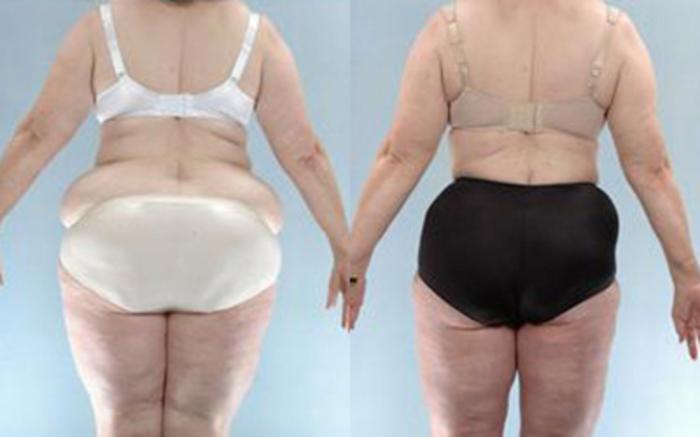 Before & After Liposuction Case 3987 View 4 View in Houston, TX