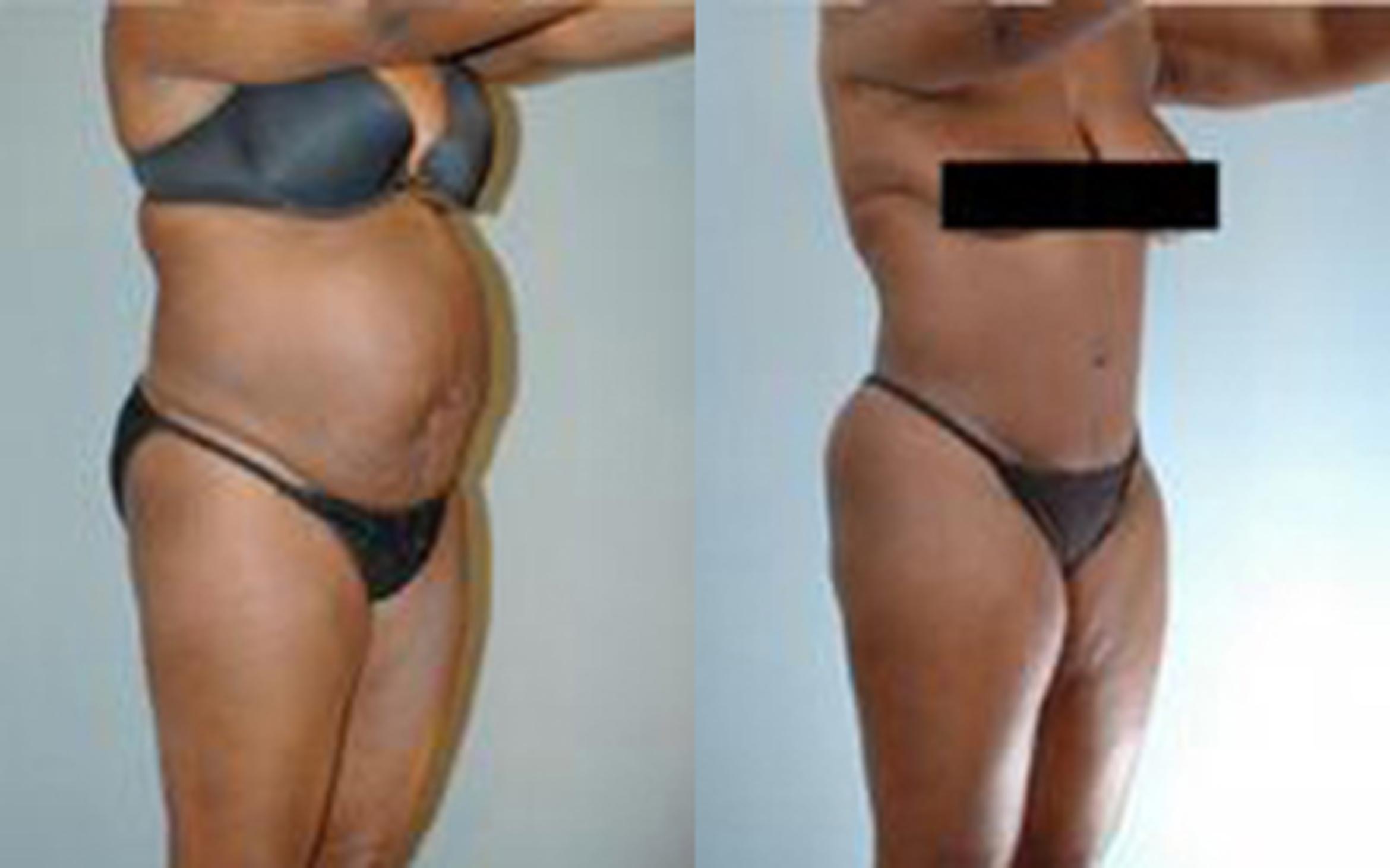 Before & After Liposuction Case 4005 View 2 View in Houston, TX