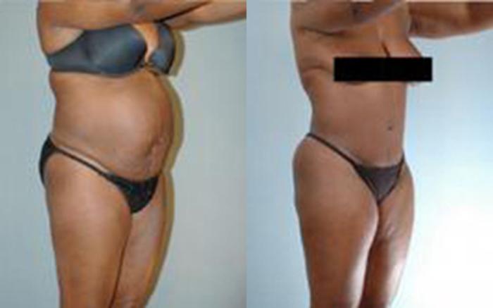 Before & After Liposuction Case 4005 View 2 View in Houston, TX