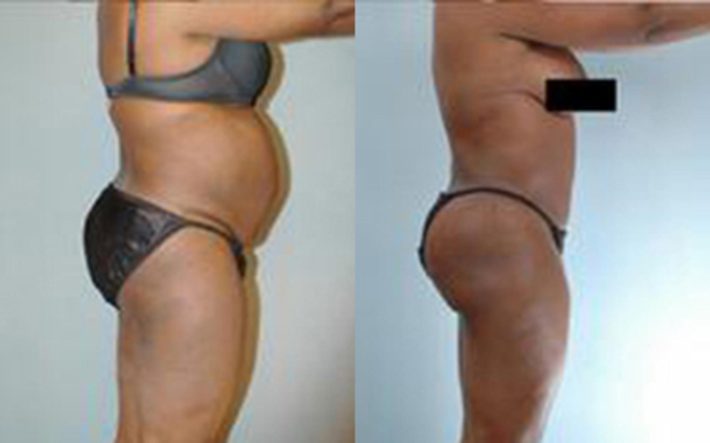 Before & After Liposuction Case 4005 View 3 View in Houston, TX