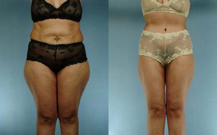 Before & After Liposuction Case 40059999 View 1 View in Houston, TX