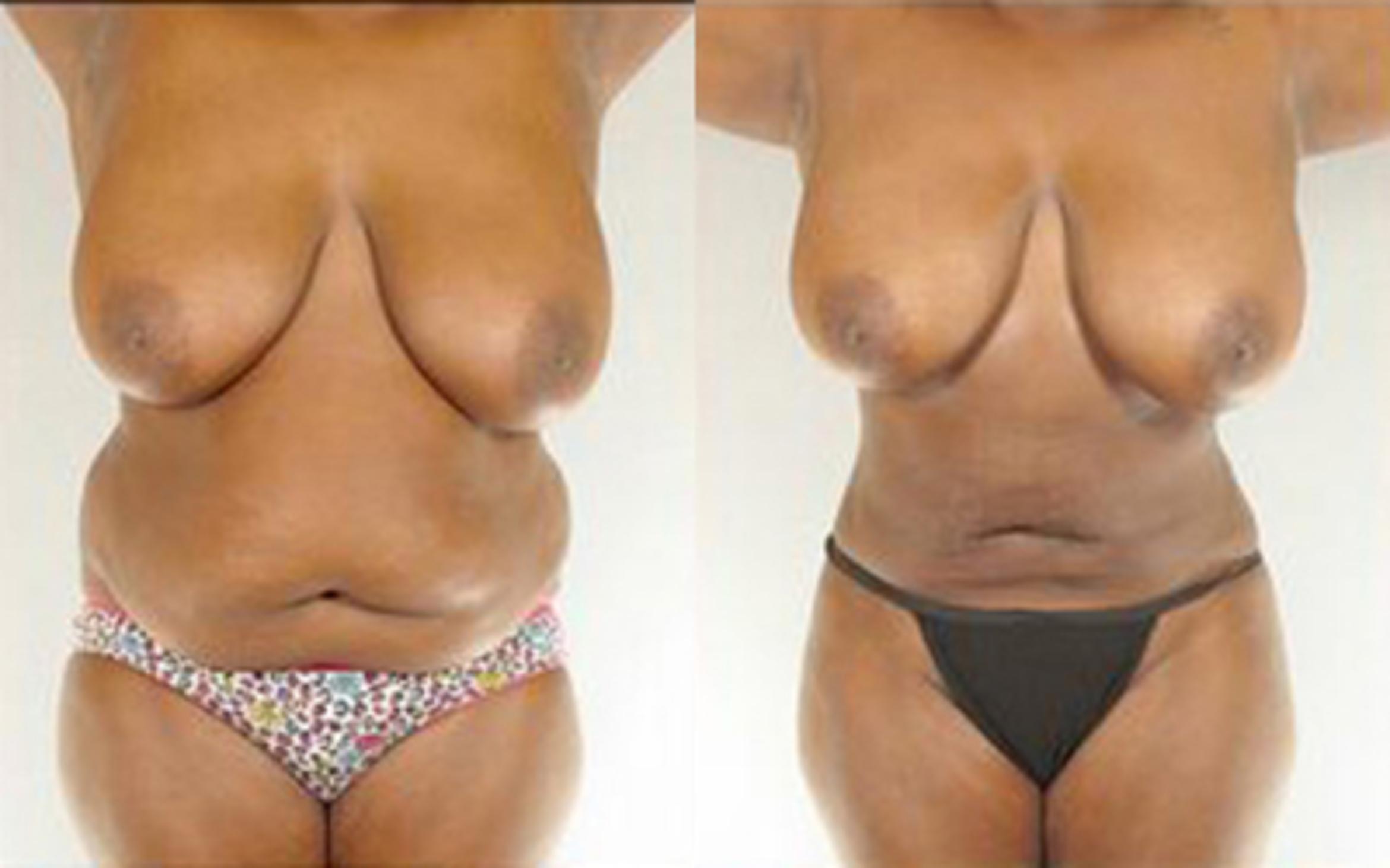 Before & After Liposuction Case 4015 View 1 View in Houston, TX