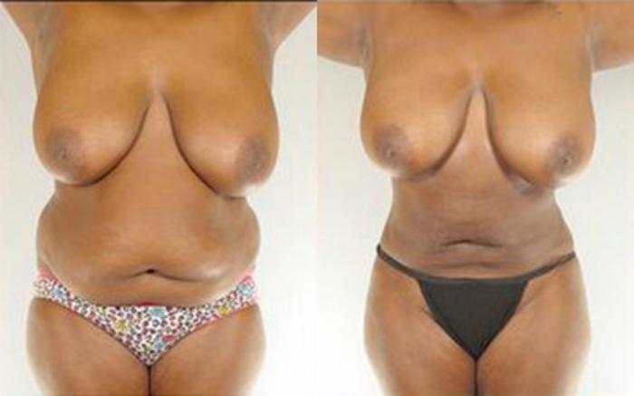 Before & After Liposuction Case 4015 View 1 View in Houston, TX