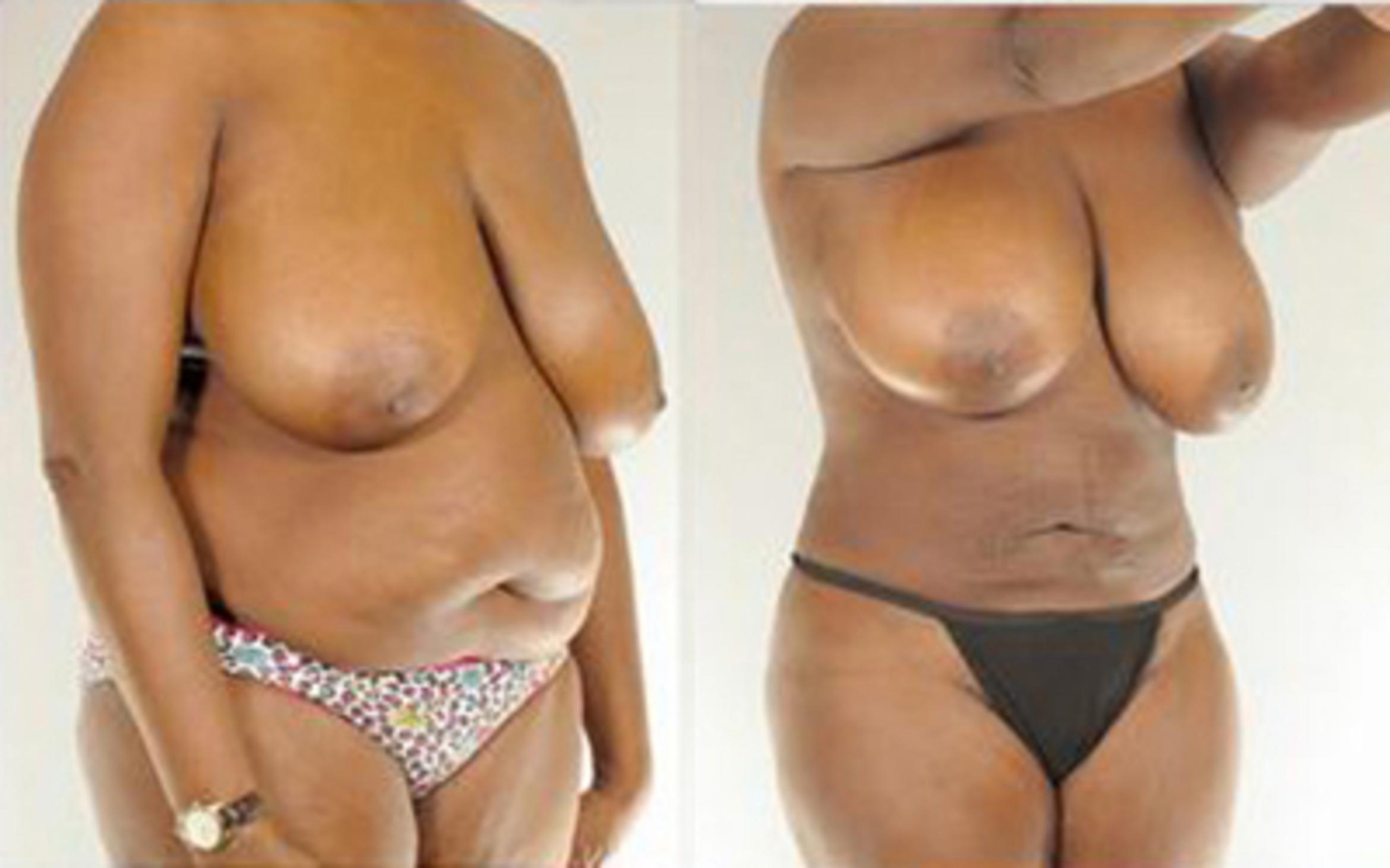Before & After Liposuction Case 4015 View 2 View in Houston, TX