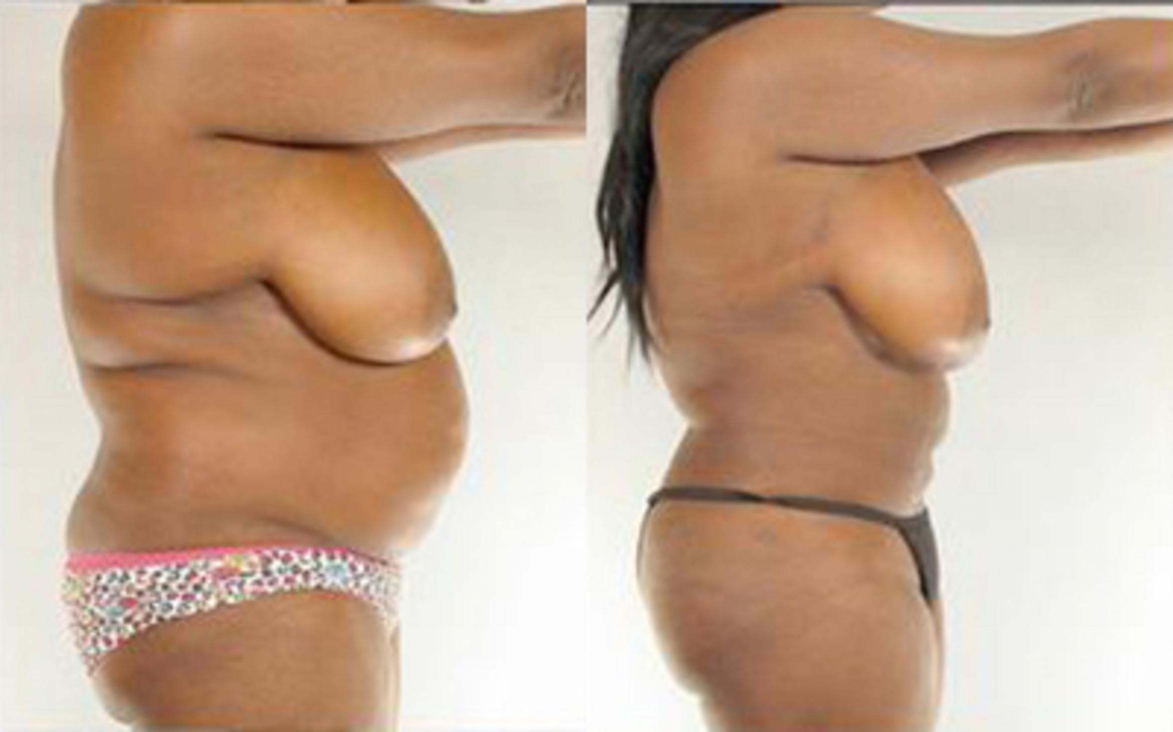 Before & After Liposuction Case 4015 View 3 View in Houston, TX