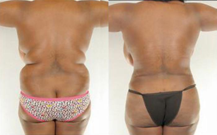 Before & After Liposuction Case 4015 View 4 View in Houston, TX
