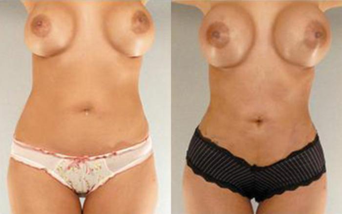 Before & After Liposuction Case 4025 View 1 View in Houston, TX
