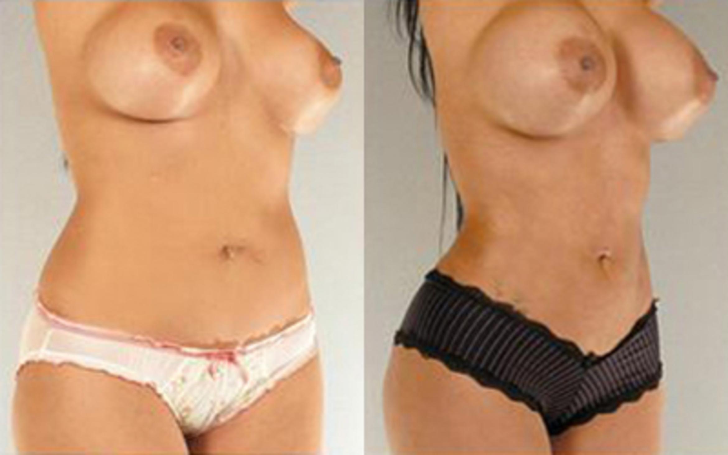 Before & After Liposuction Case 4025 View 2 View in Houston, TX