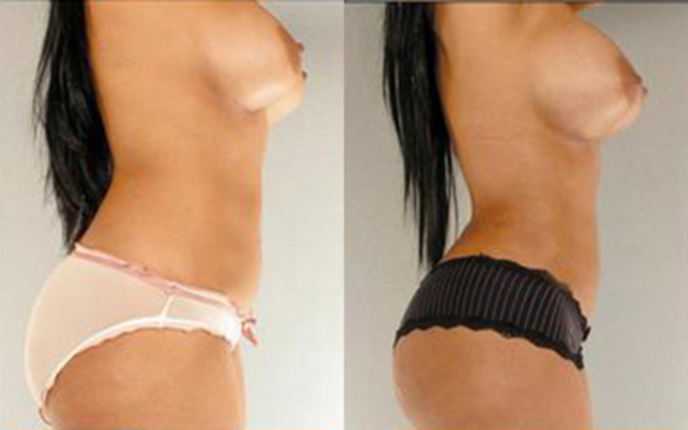 Before & After Liposuction Case 4025 View 3 View in Houston, TX