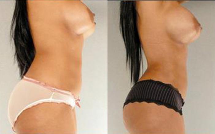 Before & After Liposuction Case 4025 View 3 View in Houston, TX