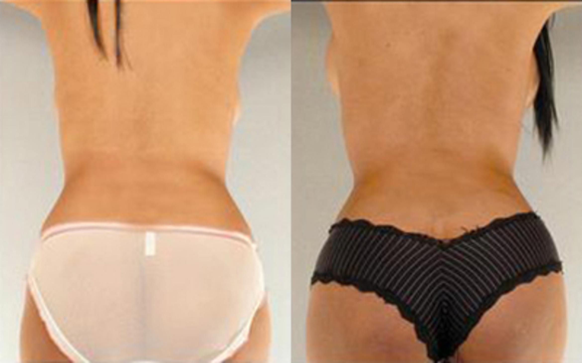Before & After Liposuction Case 4025 View 4 View in Houston, TX