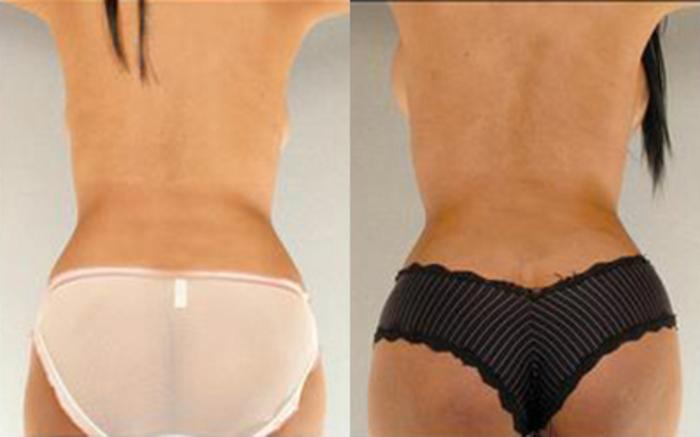 Before & After Liposuction Case 4025 View 4 View in Houston, TX