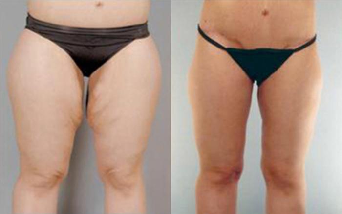 Before & After Liposuction Case 4035 View 1 View in Houston, TX