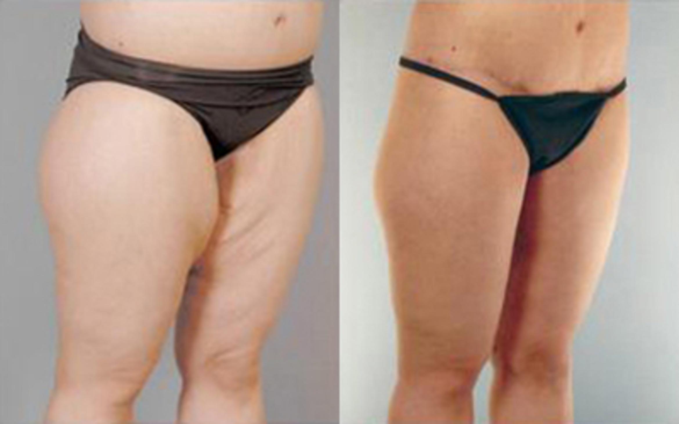 Before & After Liposuction Case 4035 View 2 View in Houston, TX