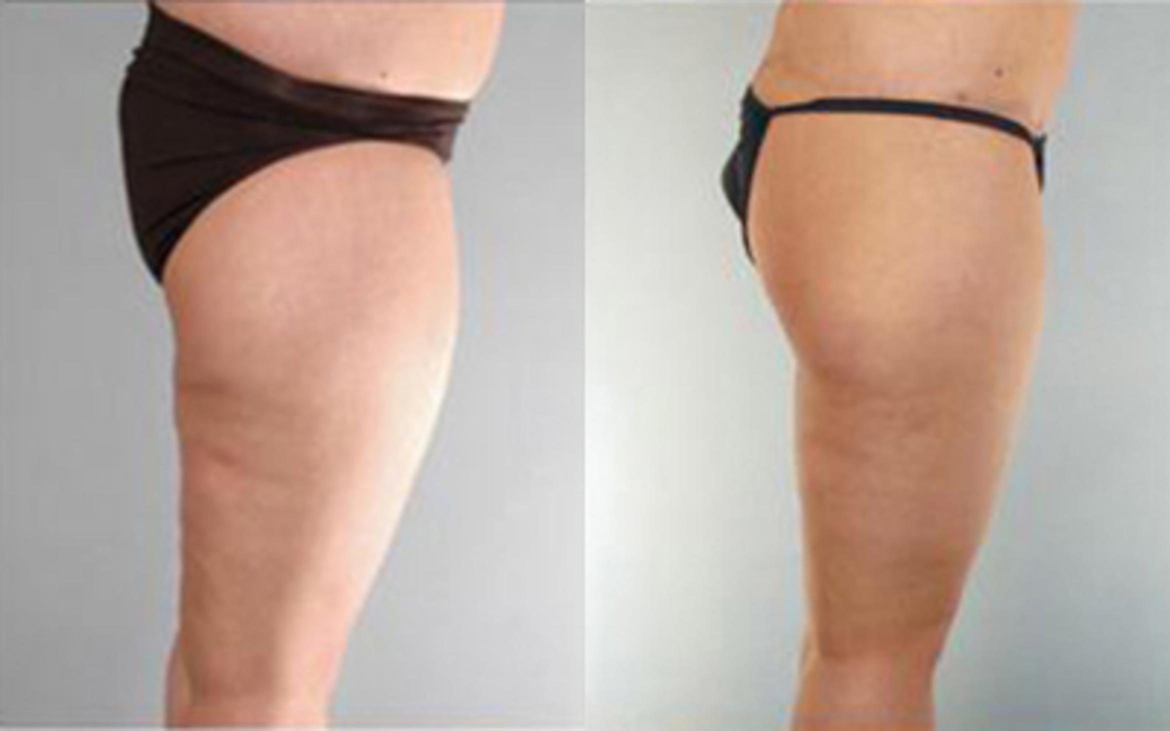 Before & After Liposuction Case 4035 View 3 View in Houston, TX