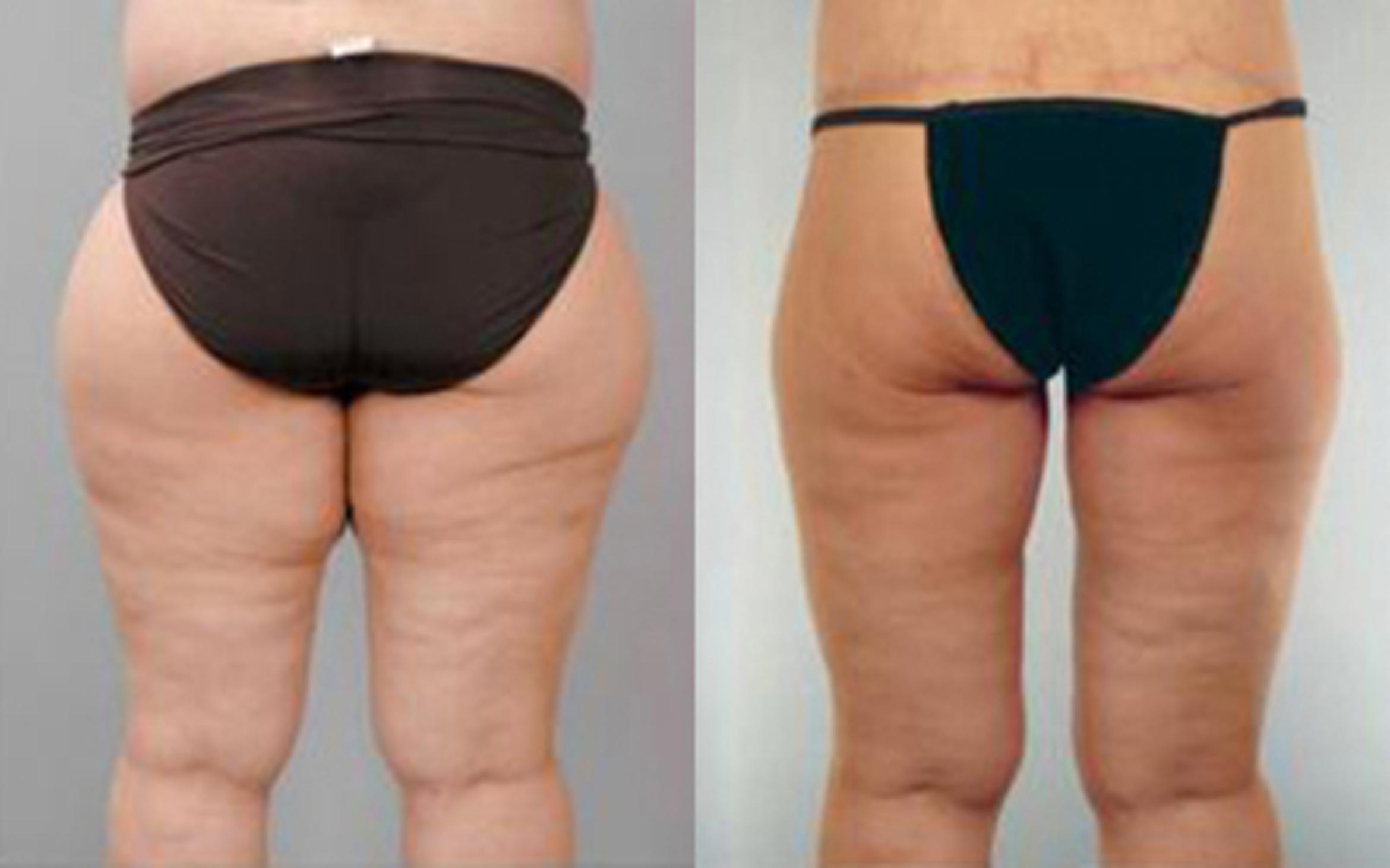 Before & After Liposuction Case 4035 View 4 View in Houston, TX