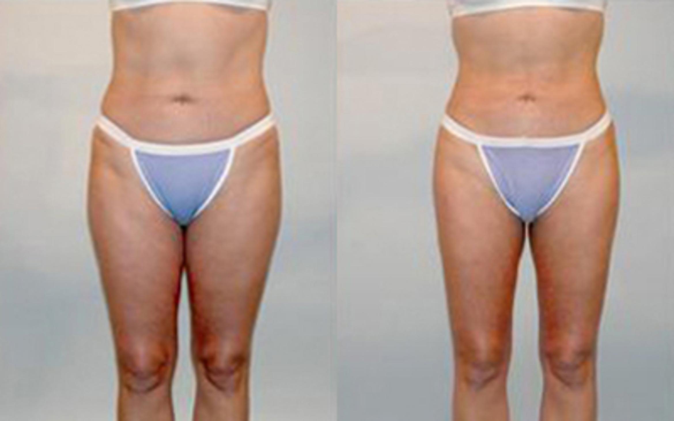 Before & After Liposuction Case 4045 View 1 View in Houston, TX