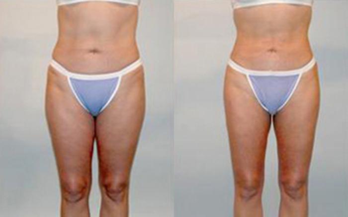 Before & After Liposuction Case 4045 View 1 View in Houston, TX