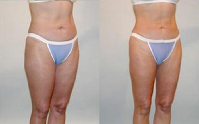 Before & After Liposuction Case 4045 View 2 View in Houston, TX
