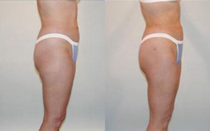 Before & After Liposuction Case 4045 View 3 View in Houston, TX