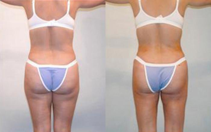 Before & After Liposuction Case 4045 View 4 View in Houston, TX