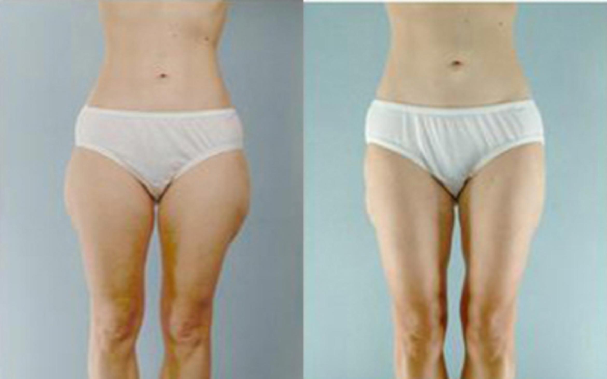 Before & After Liposuction Case 4055 View 1 View in Houston, TX