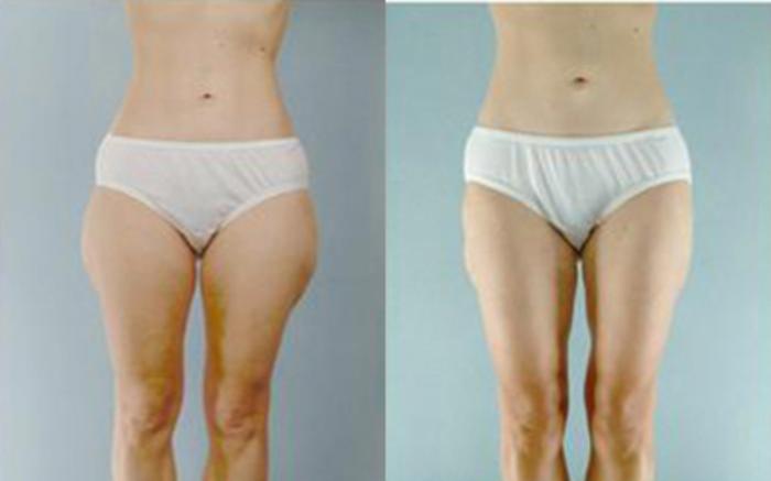 Before & After Liposuction Case 4055 View 1 View in Houston, TX